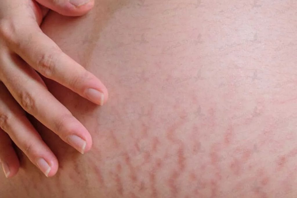 چگونه لک‌های پوستی بعد از زایمان را با نوره به صورت طبیعی از بین ببریم؟